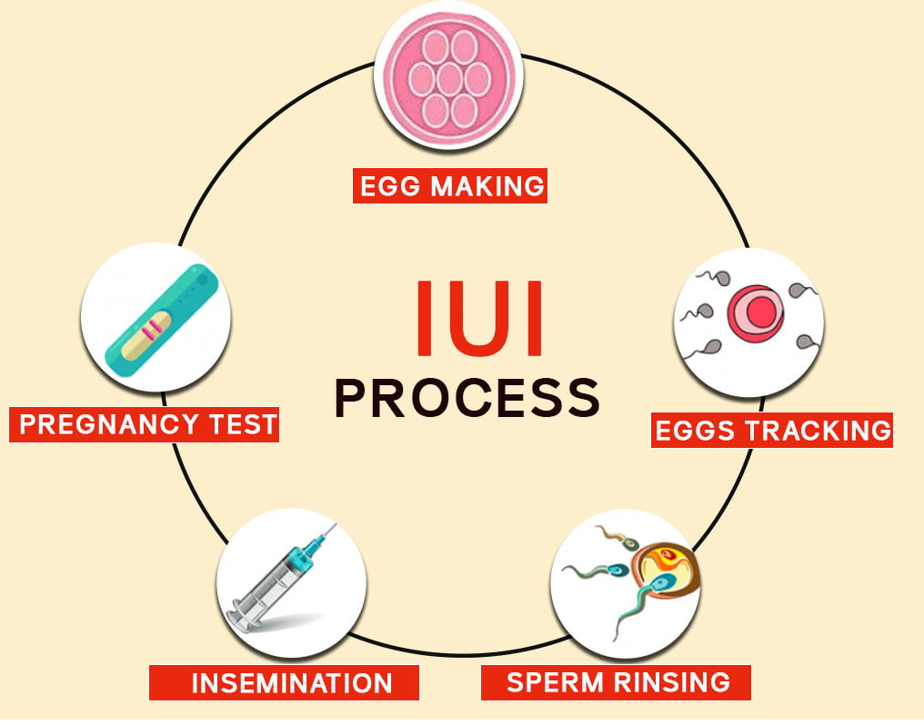 INTRAUTERINE INSEMINATION (IUI) – Dr. Shruti Sthapak